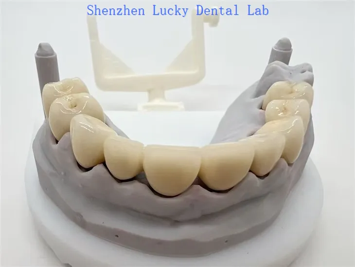 3D -tulostus bioyhteensopiva Cocr PFM Dental Bridges