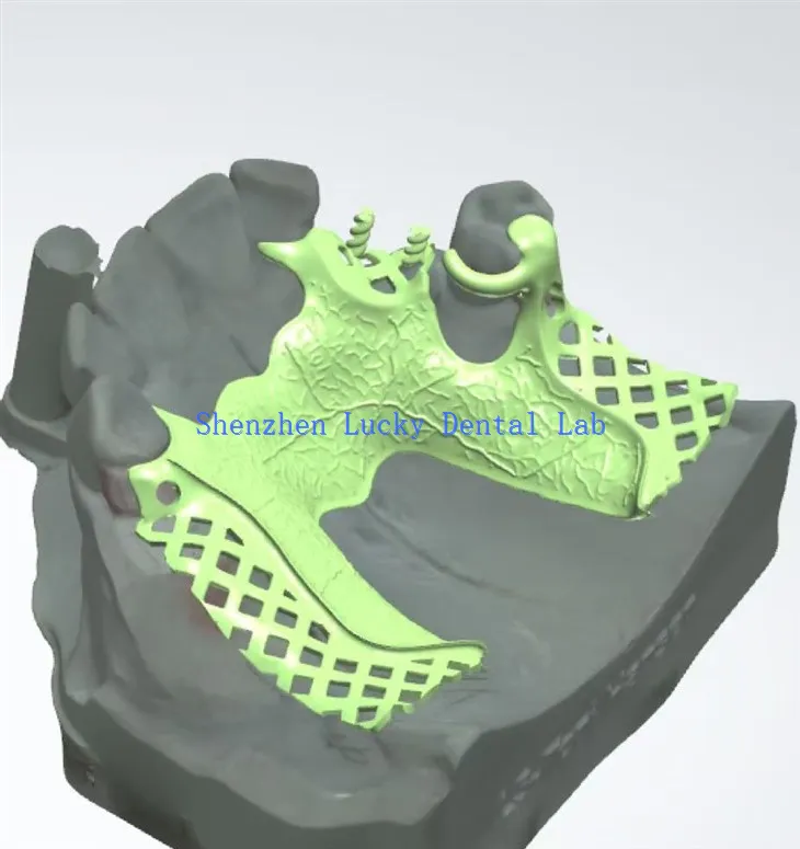 3D -tulostushammasmetallikehysvalmistajat