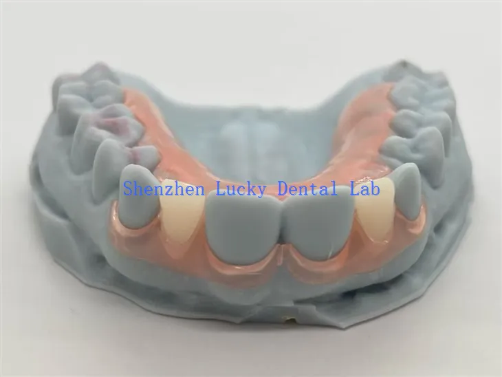 3D Print Dental TCS joustavat osittaiset hammasproteesit