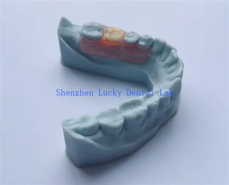 3D -tulostus hammasvalpast