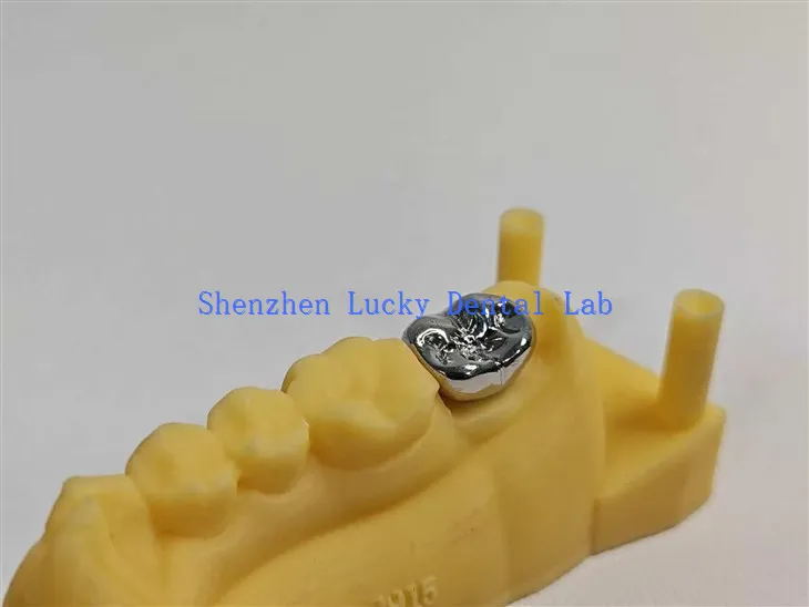 3D -tulostus korkealaatuinen hammas FMC Full Metal Crown