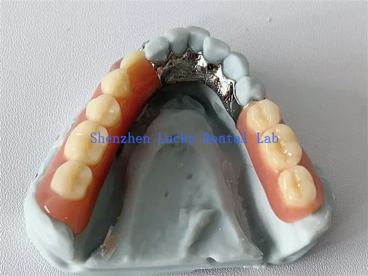 3D -tulostus Lingual Plate Dental -metallikehys akryylien hammasproteesissa