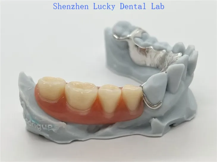 3D Print Metal Co Cr -kehys akryylihammasproteesilla