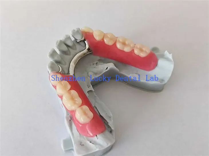 3D -tulostus osittainen akryylihammasproteesit metallikehyksellä kokeile hammaslaboratoriossa
