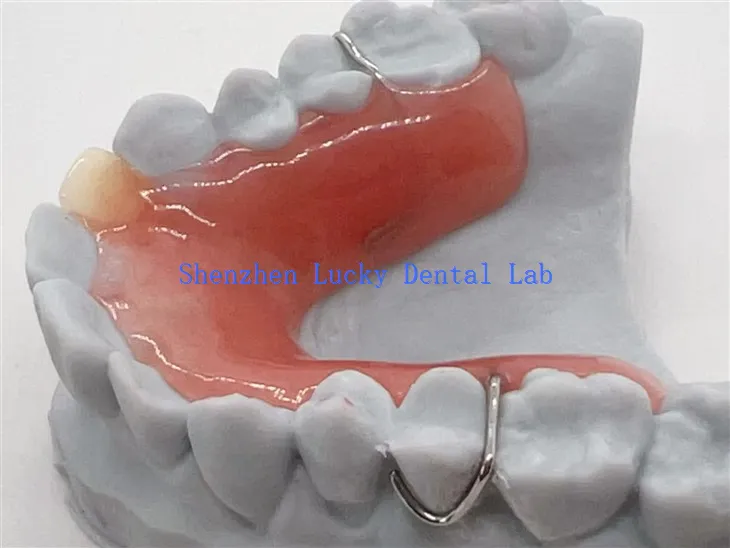 3D Print Irrotettava osittainen hammasproteesi akryylipohjalla
