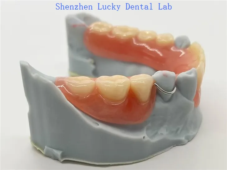 Akryylin irrotettava osittainen hammasproteesi langan lukkoon