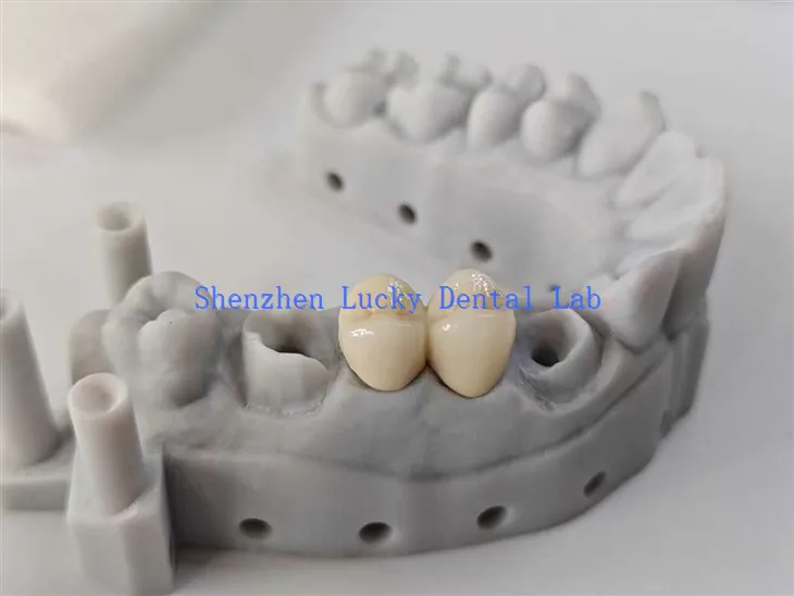 Esteettinen hammas PFM CoCR -silta