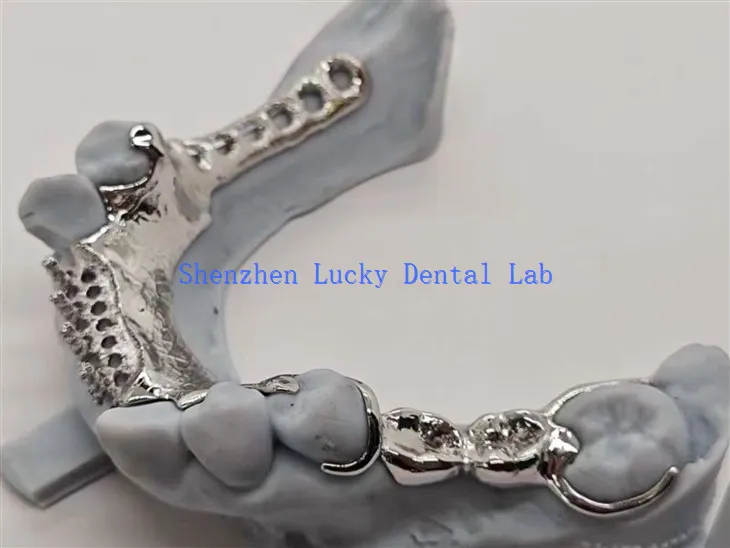 Metallirunkoinen metalliseospohjainen hammasrakenne