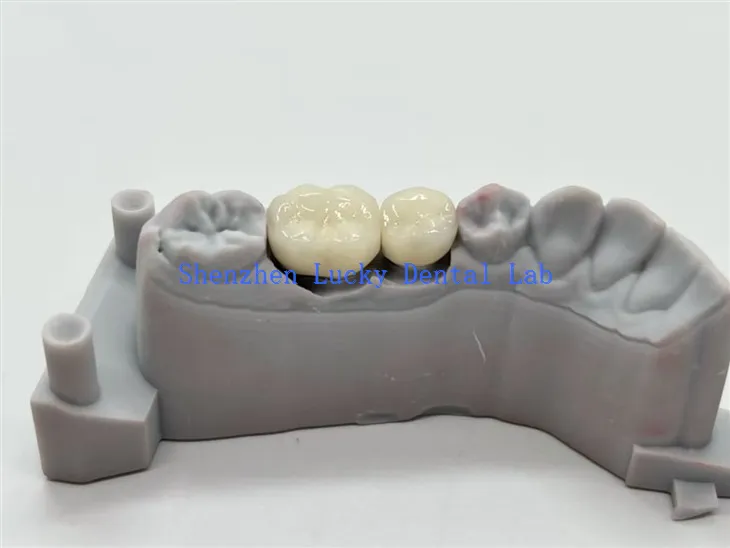 CoCr-seos PFM hammaskruunut