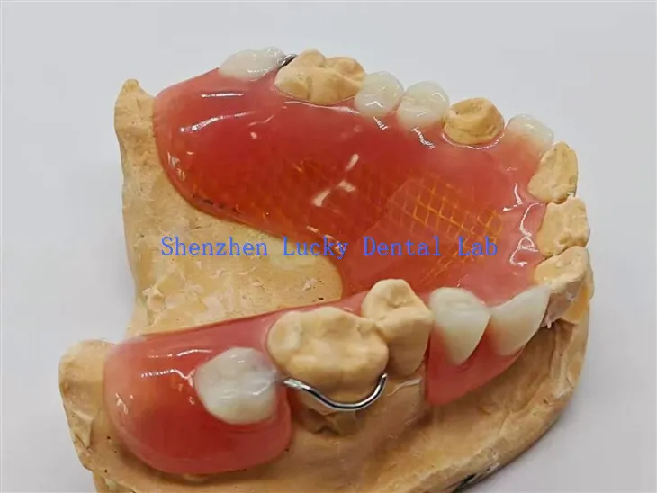 Irrotettava osittainen hammasproteesi metalliverkkoon