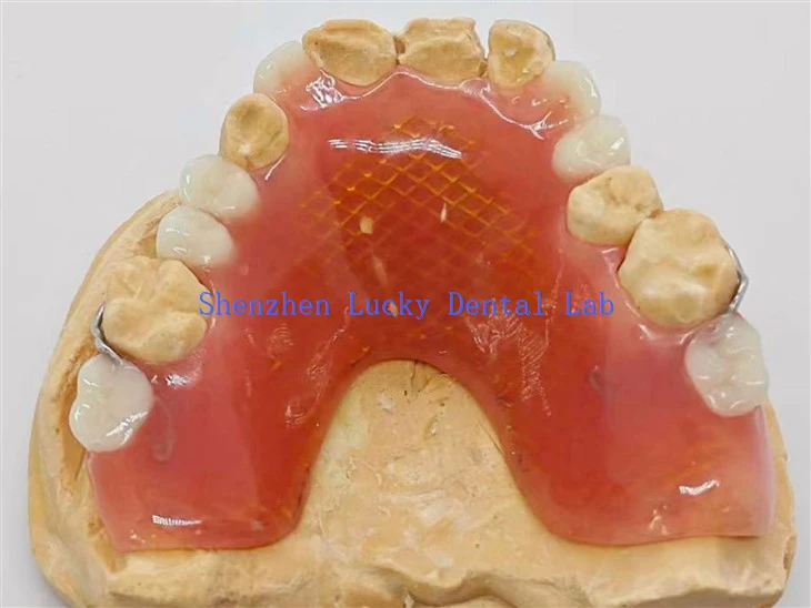 Hammashampaiden osittainen akryylien hammasproteesi metalliverkon hammaslaboratoriolla