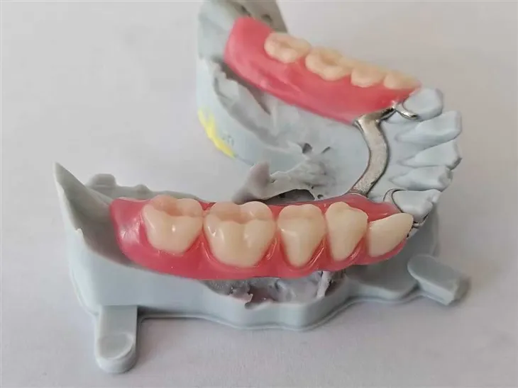 Hammashampaiden osittainen hammasproteesi metallikehyksellä/emäksellä kokeile