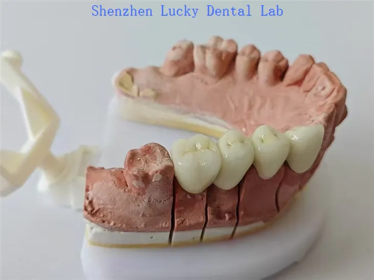Hammas PFM CoCR -siltoja ei metallimarginaali hammaslaboratorio