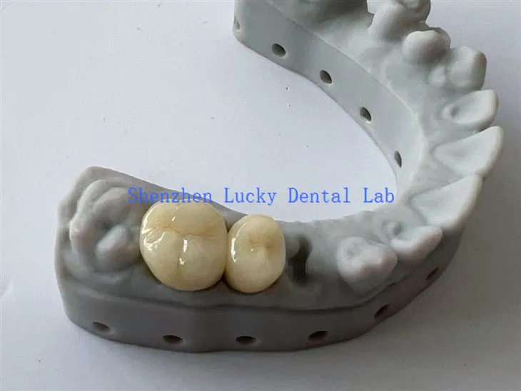 Korkealaatuiset 3D -tulostus PFM CoCR Dental Bridge -valmistajat