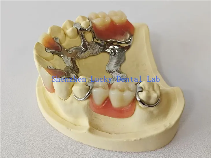 Palatal baarimetallikehys akryylihammasproteesissa